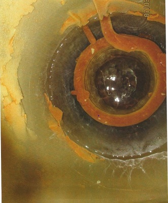 Thick layers of limescale formed after 9 months of operation